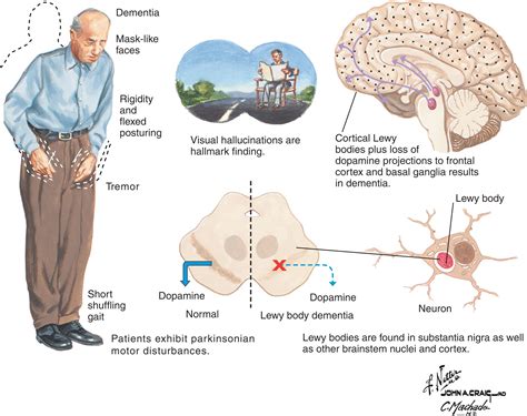 Dementia With Lewy Bodies - Clinical Tree