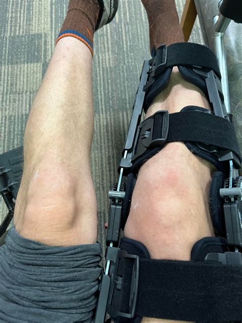 Ruptured Patellar Tendon : r/KneeInjuries