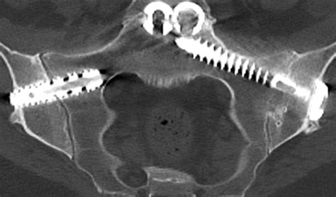 Patient-Reported and Radiographic Outcomes After Revision Sacroiliac Joint Fusion ...