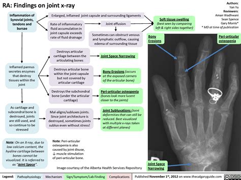 Rheumatoid arthritis (RA): X-ray features | Calgary Guide
