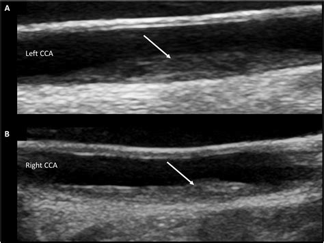 Carotid Artery Ultrasound