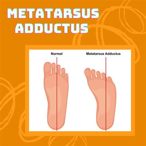 Adduction Of Foot