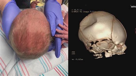 Doctors get creative to help baby born with dent in skull | khou.com