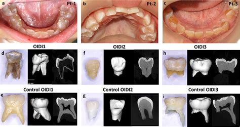 Dentinogenesis imperfecta | News | Dentagama