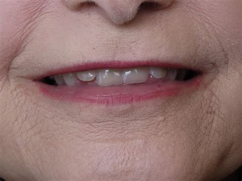 Smile Gallery - Cosmetic Dentistry Before and After Photos - Aspen ...