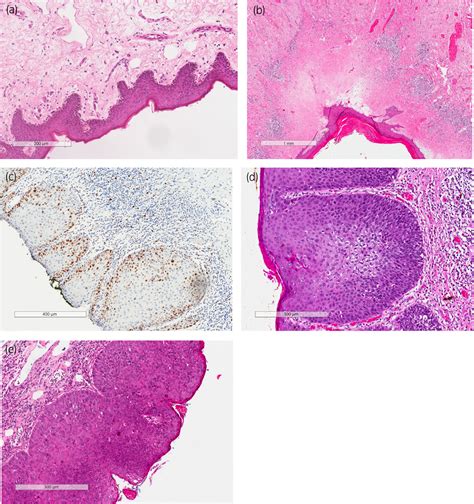 Erythroplasia Of Queyrat Histology