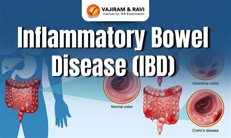 Inflammatory Bowel Disease, Types, Symptoms, Causes, Latest News