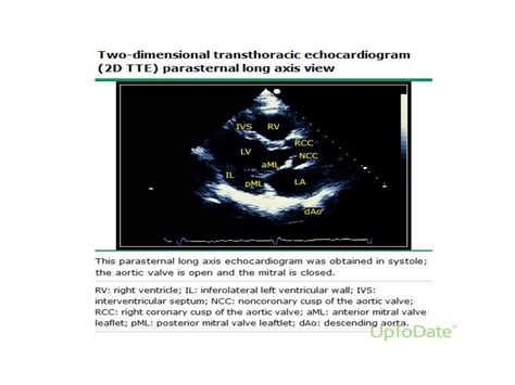 Mitral stenosis Echocardiography | PPT