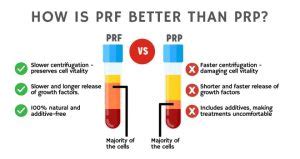 Injectable PRF 的图像结果