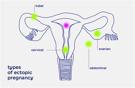 Ectopic pregnancy - how to recognize and act in time