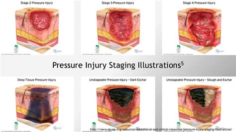 Deep Tissue Pressure Injury
