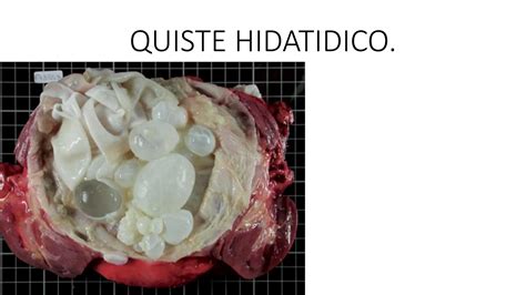 QUISTE HIDATIDICO.pptx