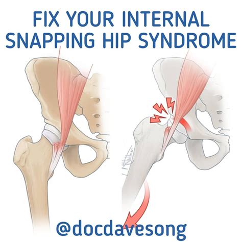 Snapping Hip Stretches