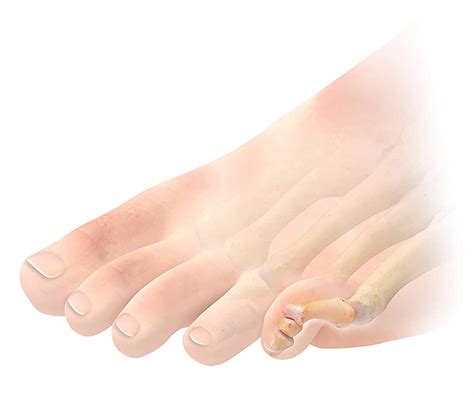 What to Expect During Hammer Toe Surgery