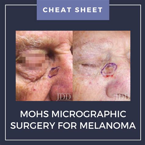 Mohs Micrographic Surgery for Melanoma (MMS-M) | Cheat Sheet - Next Steps in Dermatology