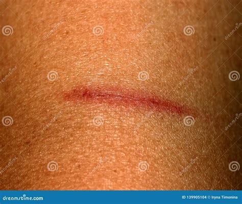 What Is Abrasion Scratch at Hannah Cadell blog