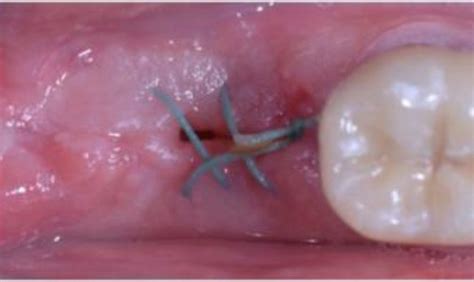 Image result for Stitches After Tooth Extraction