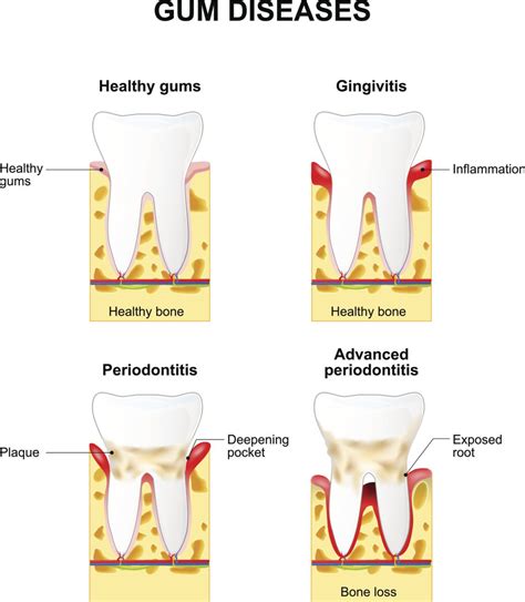 Gum Disease FAQs Plano TX | Periodontal Treatment Dallas