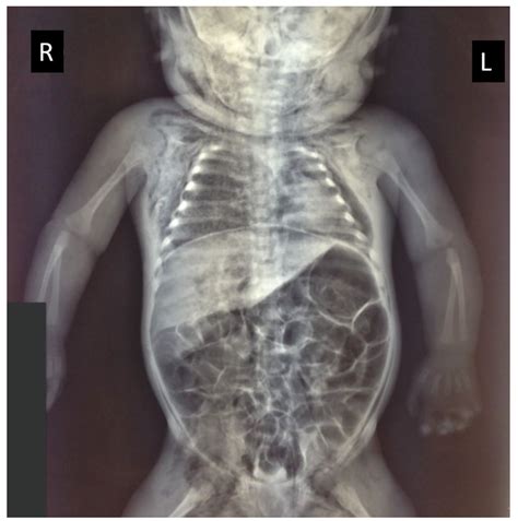 Congenital Cystic Adenomatoid Malformation (CCAM) Type II: A Rare Case ...