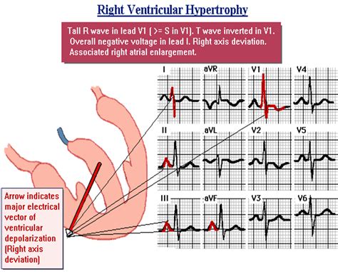 Right Ventricular Hypertrophy (RVH) pada EKG? | SholehShare