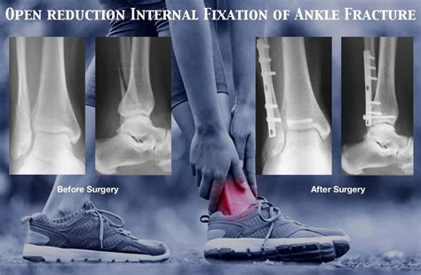 Lateral Malleolar - Robert Sheinberg, DPM | Weston, FL Podiatrist