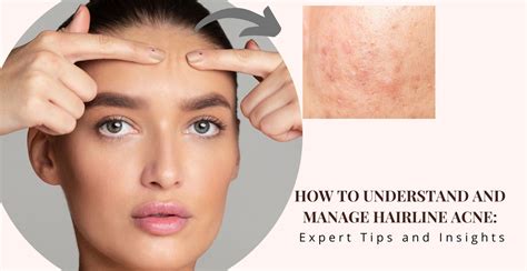 How to Understand and Manage Hairline Acne | Clinikally