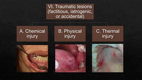 Image result for Classification Periodontitis