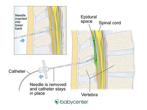 Quels sont les avantages et les inconvénients d'une péridurale ...