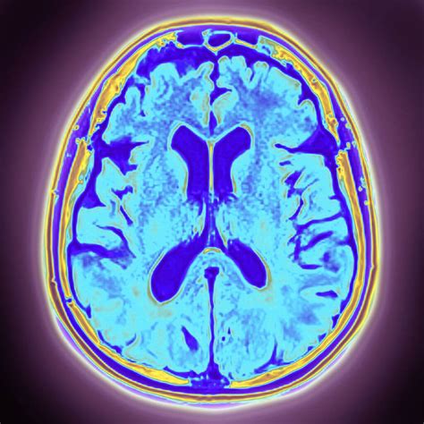 Dementia With Lewy Bodies: What You Need to Know - Clinical Advisor - phases of lewy body dementia