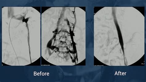 Video : May-Thurner syndrome and nut cracker syndrome