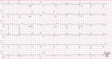 Type Ii Heart Block