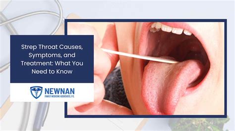 Treatment Strep Throat Symptoms Recurrent Group A Streptococcus