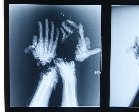 Gonzagas broken hand X-Ray | Sherdog Forums | UFC, MMA & Boxing Discussion