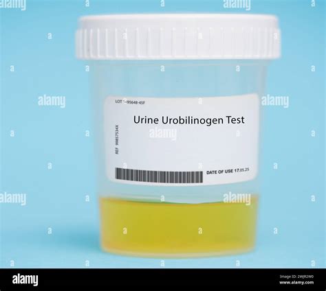 Urine urobilinogen test Stock Photo - Alamy