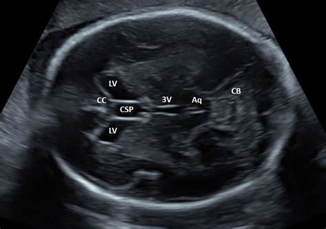 Posterior Ventricle Ultrasound