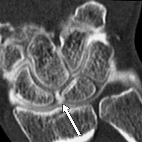 Scapholunate Advanced Collapse and Scaphoid Nonunion Advanced Collapse ...