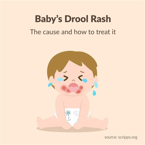 Baby's Drool Rash: The Causes and How to Deal With It - mamaway ...