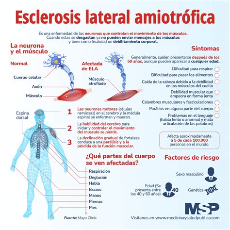 Esclerosis Lateral Amiotrófica - Infografía