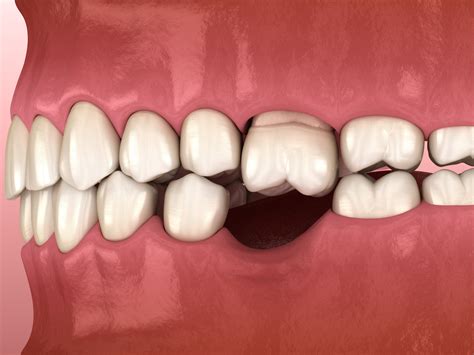 牙齿掉了一颗怎么办 - 单颗牙缺失 - 上海泰康拜博口腔医院