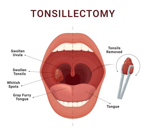Understanding Tonsillitis: Symptoms, Causes, and Treatments | Annapolis and Severna Park, MD