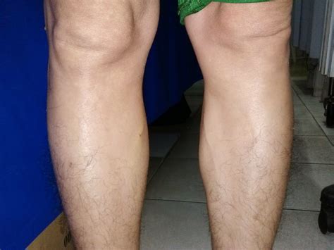 VIETNAMESE MEDIC ULTRASOUND: CASE 300: MULTIPLE BONE TUMORS, Dr PHAN ...