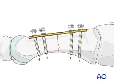 Compression Plate Fixation 的图像结果