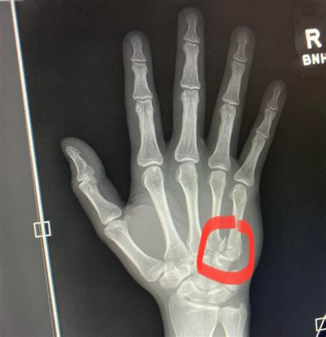 I have a boxer’s fracture in my right hand and I’m really worried about the long term affects on ...