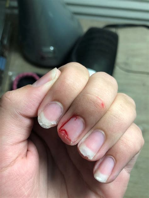 i broke my acrylic nail and it's bleeding