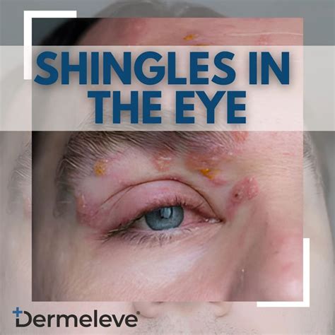 Dermeleve® on LinkedIn: Shingles in the Eye: Symptoms and Treatments