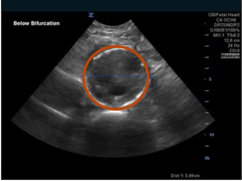 Iliac Artery Aneurysm, Ultrasound 2 Annotated. JETem 2020 - JETem