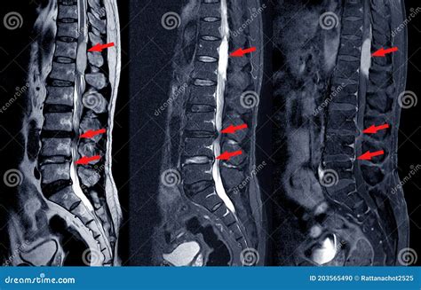 MRI Scan of Lumbar Spines of a Patient Finding Spinal Mass at Lt.side T12-L1 Level Severe ...