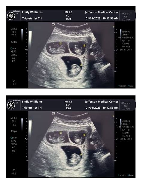 Picture Frames For Twins Ultrasound at Robert Fabry blog