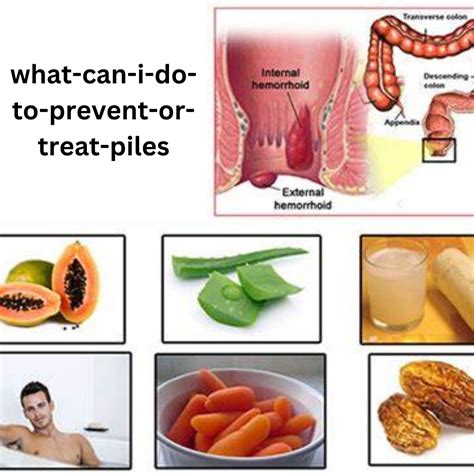 Piles Treatment Home Remedies For Hemorrhoids Aka Piles - what doctor treats hemorrhoids