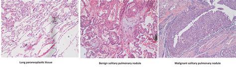 Metabolic Profiling of Plasma from Benign and Malignant Pulmonary ...